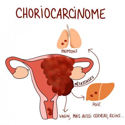 Choriocarcinome 2